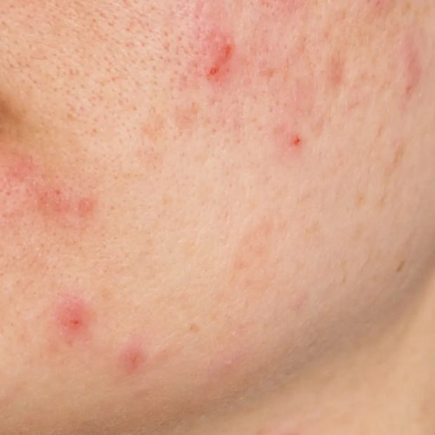 Jabón Facial Anti acné | Acni G